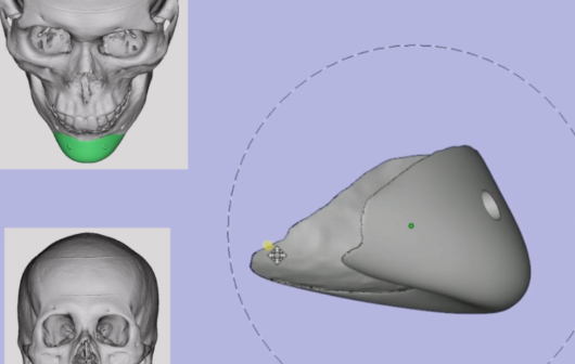 3D打印脸部假体佩戴过敏？选对这两个材料避免红肿