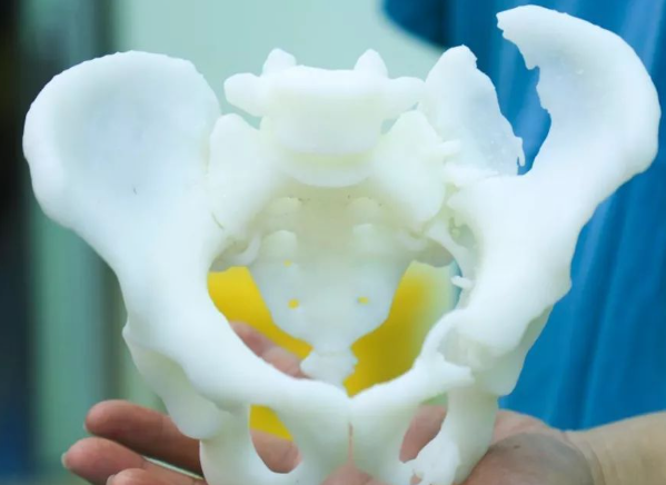 3D打印骨盆模型如何辅助治疗髋关节发育不良？